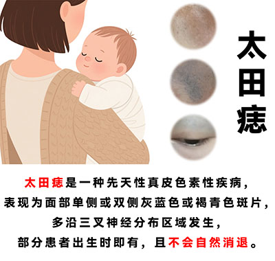太田痣需要怎么办？南京治疗太田痣的医院哪里好？