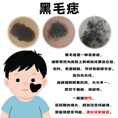南京胎记研究院怎么样？黑毛痣的科学处理方式